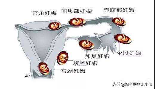 你真的了解宫外孕吗?-一例输卵管间质部女妊娠破裂分享